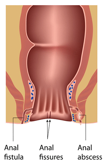 piles treatment in chandigarh